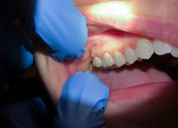 Best Emergency Dental Extractions in Harveys Lake, PA